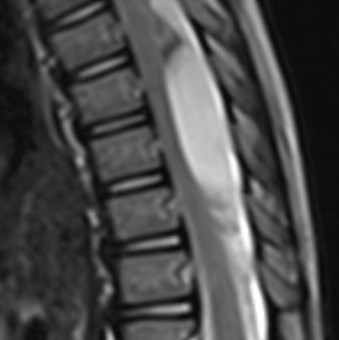 T7-T10 Laminoplasty for Resection of Intradural Extramedullary
