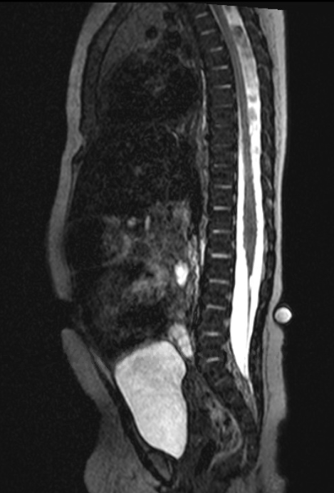 Lumbar Laminectomy For Sectioning Of Thickened Filum Terminale - Cns.org