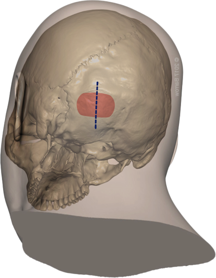 Suboccipital Craniectomy for Posterior Fossa Meningioma Suboccipital Craniectomy for Posterior Fossa Meningioma
