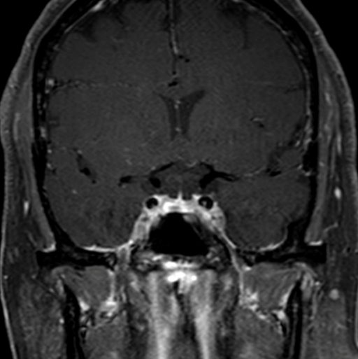 Endoscopic Endonasal Transsphenoidal Resection Of A Pituitary Adenoma For Cushings Disease 4044