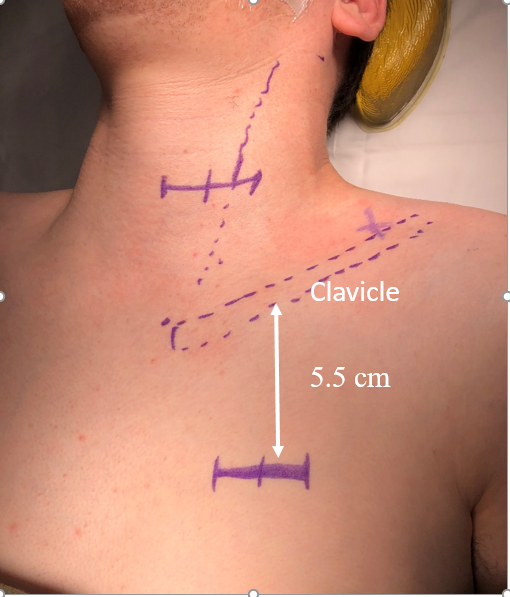 Image 09303: Cervical Nerve Stimulator Device Placement Surgery Illustration