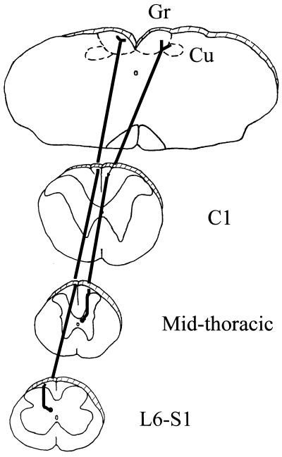 Mid Thoracic Punctate Midline Myelotomy for the Treatment of