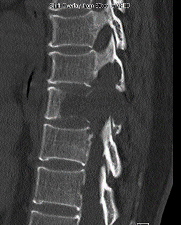 Costotransversectomy for spinal tumor - cns.org