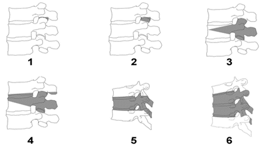 Pedicle Subtraction Osteotomy for Treatment of Sagittal Plane Deformity ...