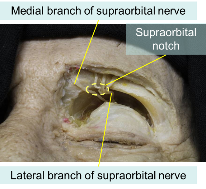 supraorbital nerve cadaver