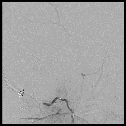 Endovascular embolization of left parietal borden type IV dural AV ...