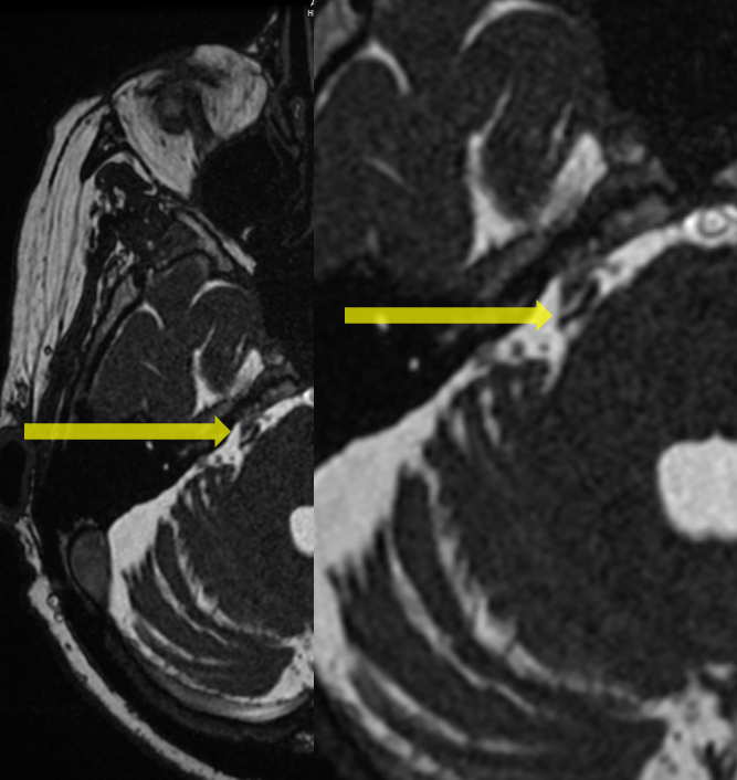 Fully Endoscopic Right Retrosigmoid Craniotomy for Microvascular