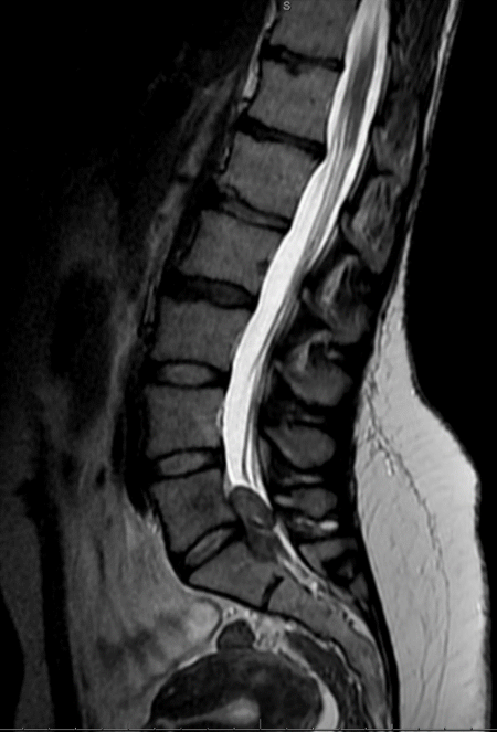 Posterior approach for giant sacral schwannoma - cns.org