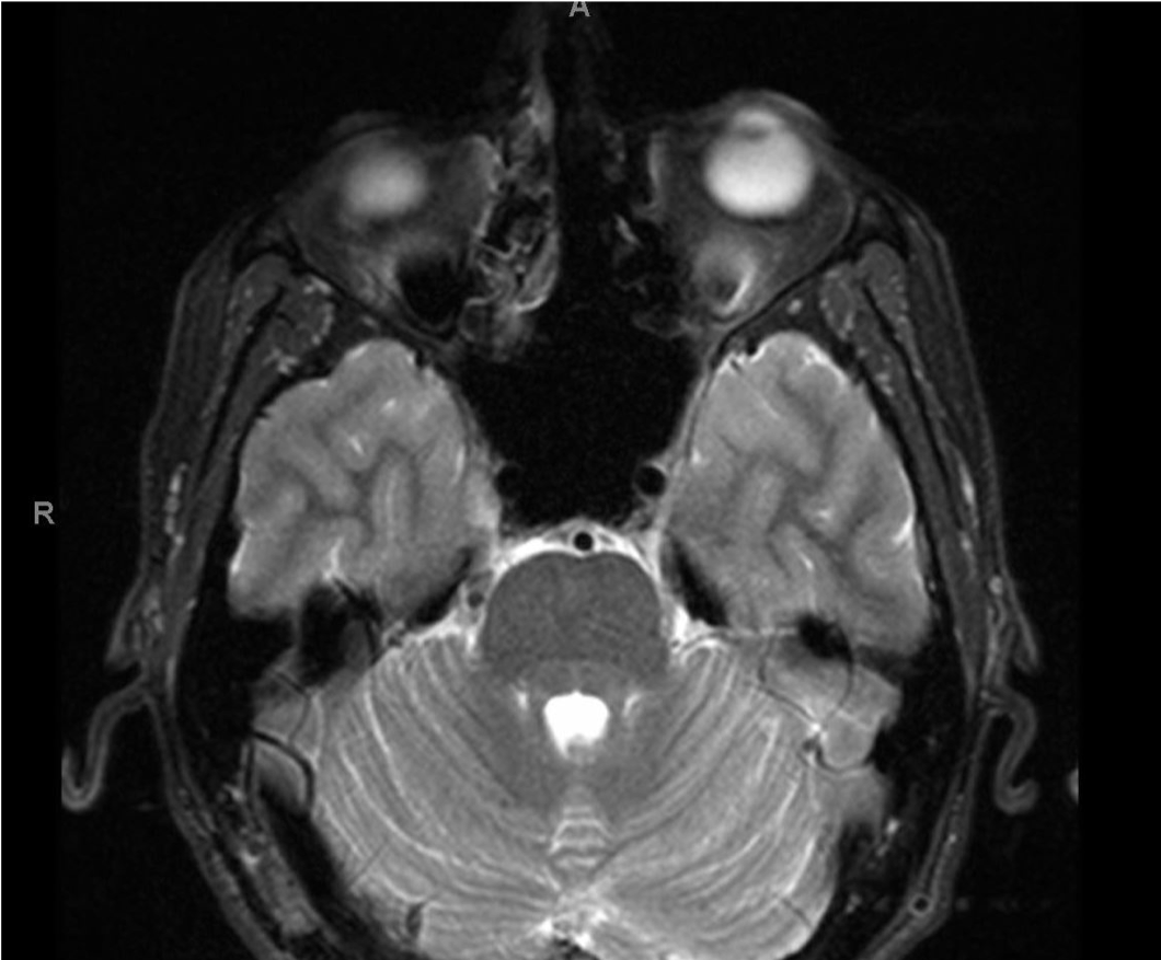 Microvascular and Radiofrequency Lesioning for Trigeminal