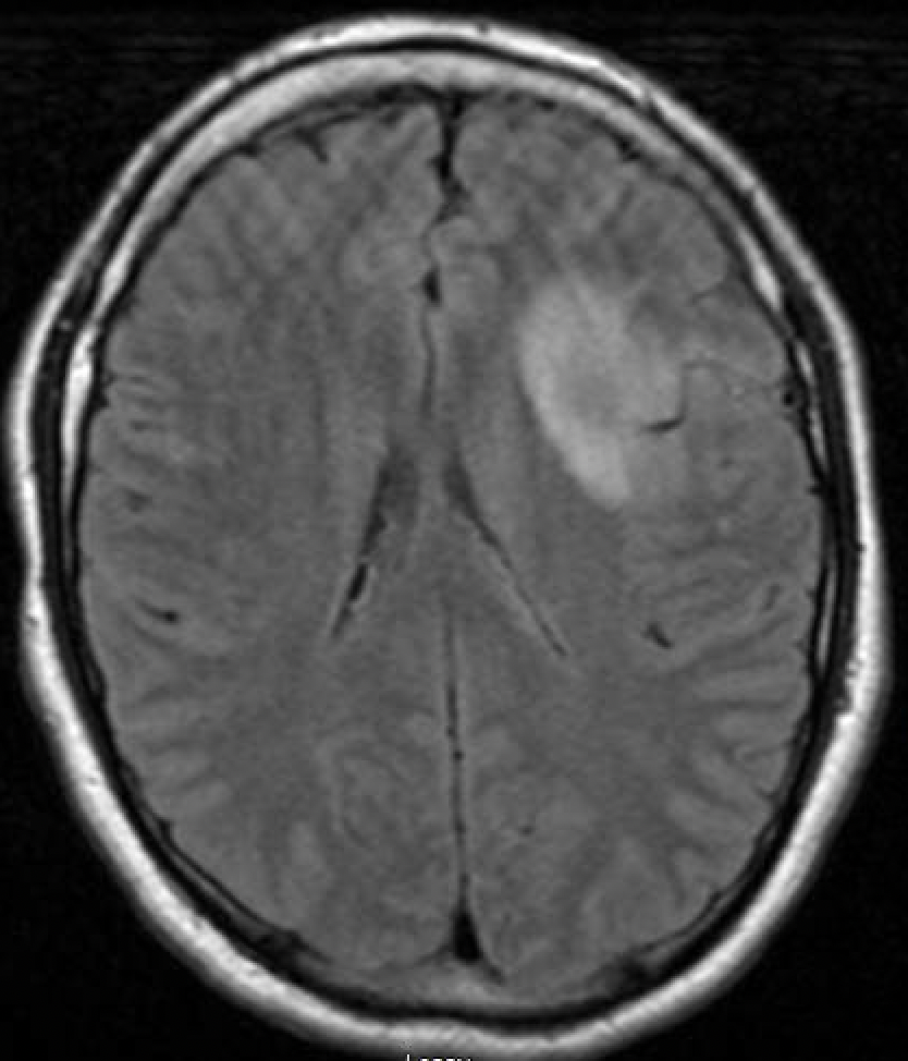 Trans-Sylvian Approach for Resection of Insular Glioma. - cns.org