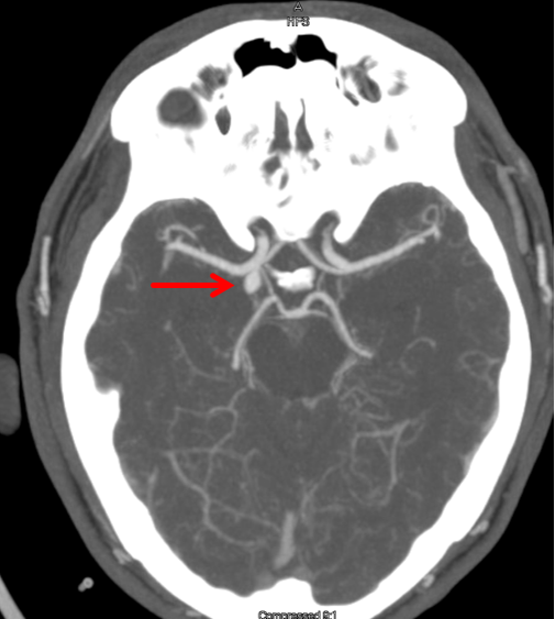 Balloonassisted coiling of ruptured aneurysm