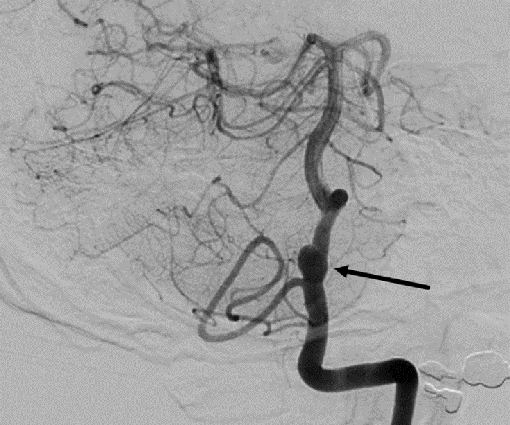 Lateral transcodylar craniotomy for PICA aneurysm - cns.org