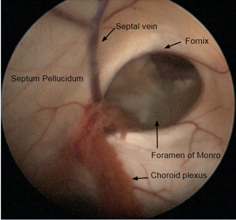 Endoscopic Third Ventriculostomy For The Treatment Of Obstructive