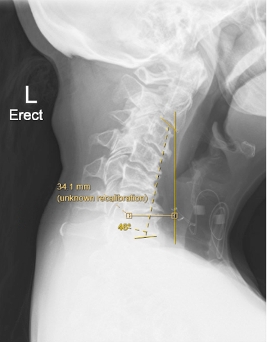 Spinal Cervical Deformity - Neurosurgery