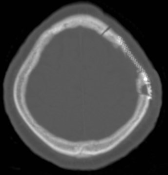 Left parietal craniotomy for elevation of depressed skull fracture ...