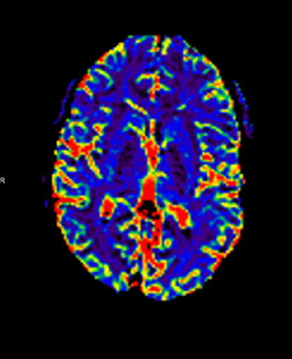 Left Encephalodurosynangiosis for Moyamoya - cns.org