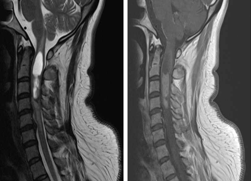 Laminectomy for Ependymoma of the Cervical Spine