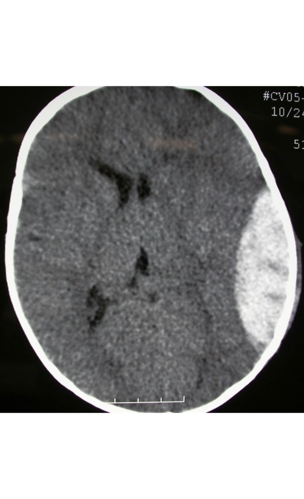 Temporoparietal Craniotomy For Epidural Hematoma Cns Org