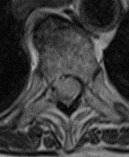 Transpedicular Approach for Resection of Ventral Thoracic Meningioma ...