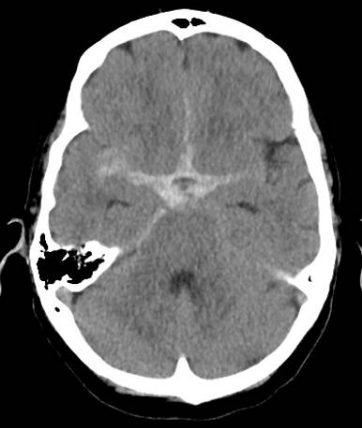 Bilateral MCA Bifurcation Aneurysm - cns.org