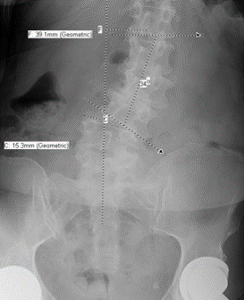 Combined Anterior and Posterior Approach for Treatment of 