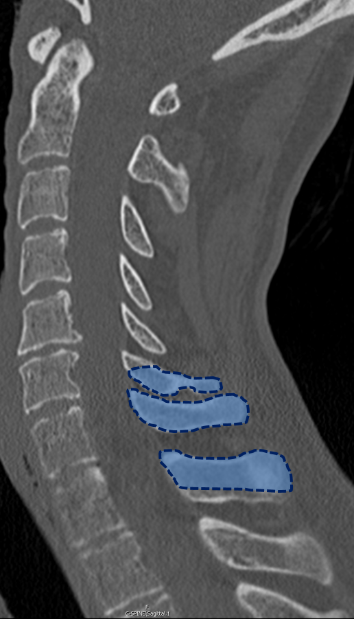 Posterior extension osteotomy for ankylosing spondylitis, chinonchest