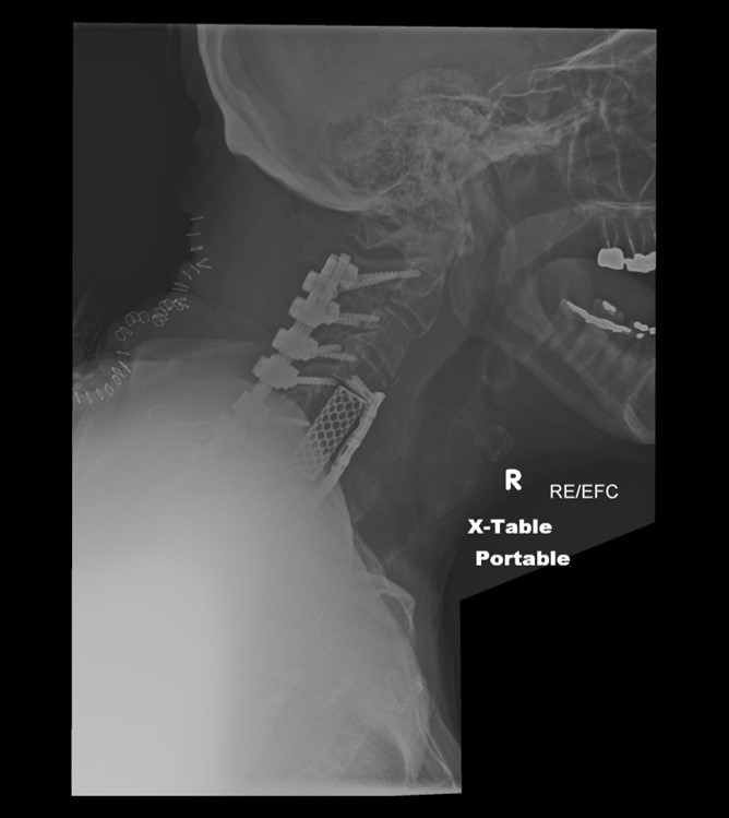 Progressive kyphosis after epidural abcess drainage, for