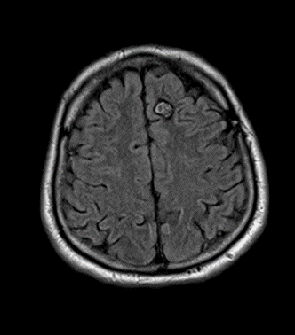 Left frontal craniotomy for resection of left frontal cavernous ...