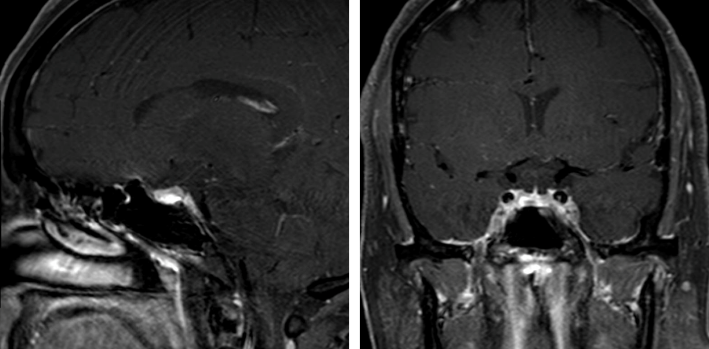 Endoscopic Endonasal Transsphenoidal Resection Of A Pituitary Adenoma ...