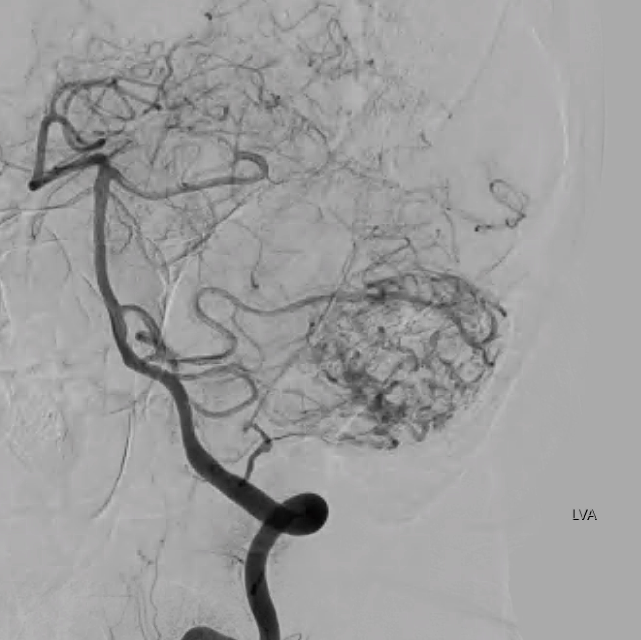 Preoperative embolization of a cerebellar hemangioblastoma