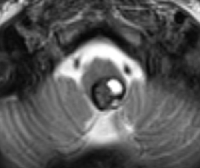 Figure 1 From Surgical Approaches To Intramedullary Cavernous