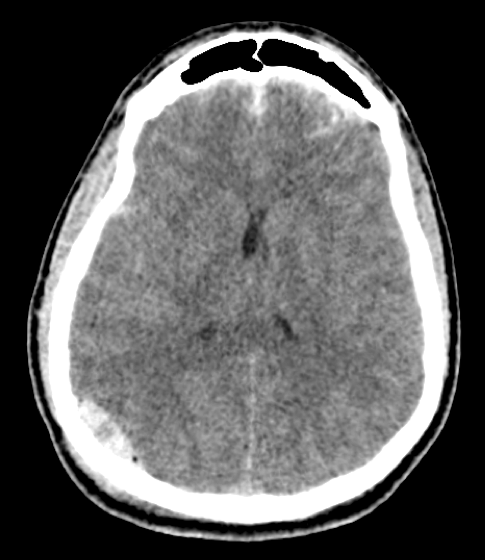 Occipital Craniotomy for Evacuation of Epidural Hematoma - cns.org
