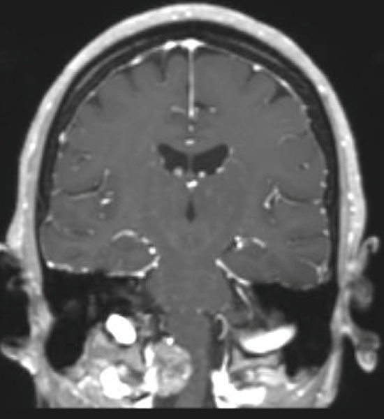 foramen magnum mri