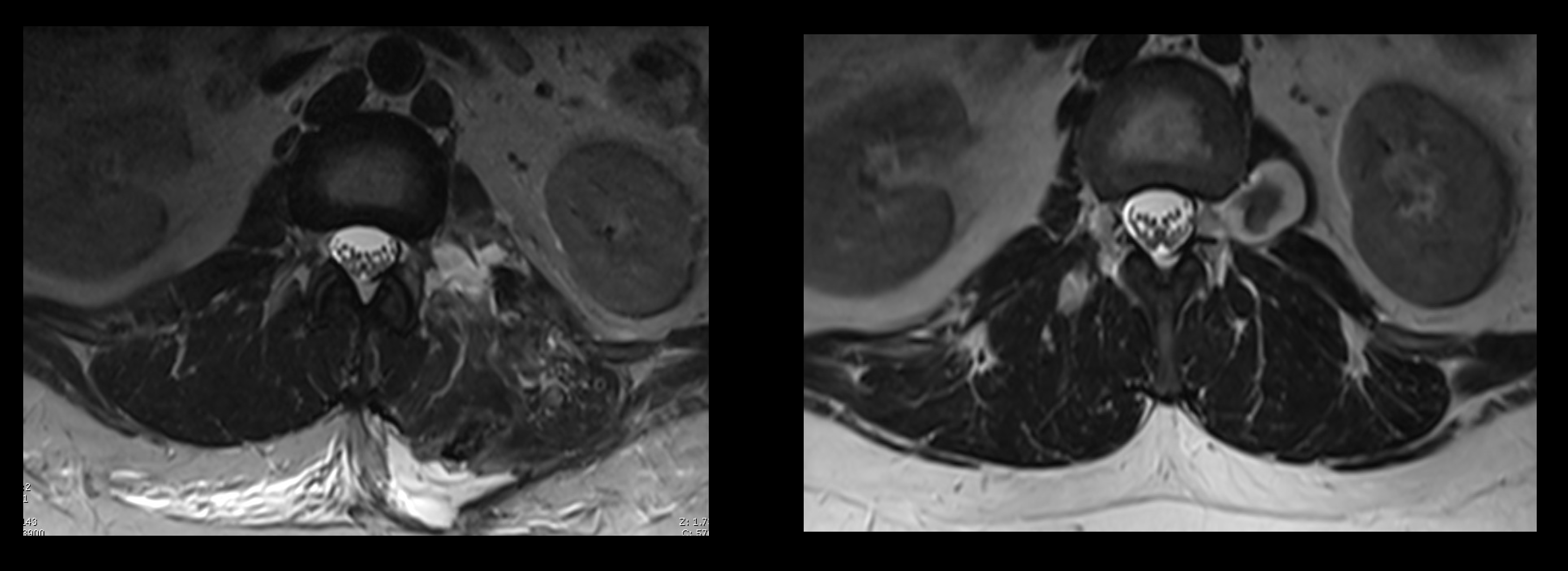 MIS Wiltse Approach for Resection of an Extra-Foraminal Neurofibroma ...