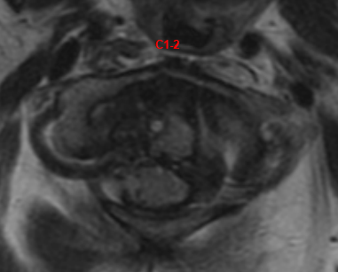 icd 10 code for cervicalgia of occipito atlanto axial region