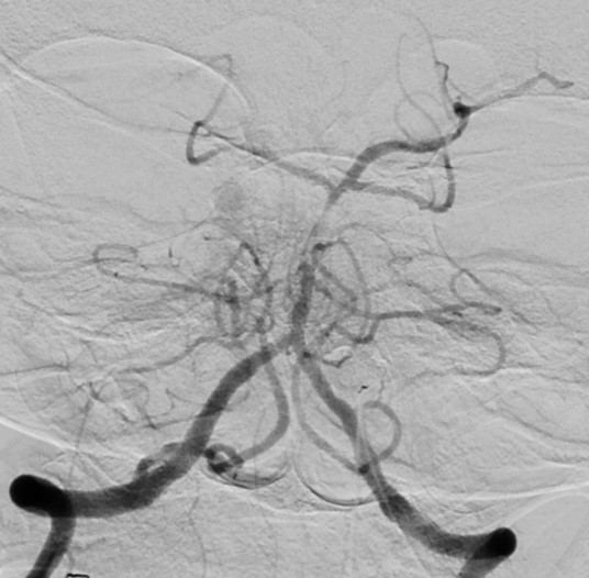 Right Radial Approach Mechanical Thrombectomy for Posterior Circulation