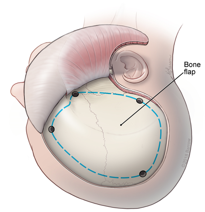 Trauma Flap Decompressive Hemicraniectomy  Neupsy Key