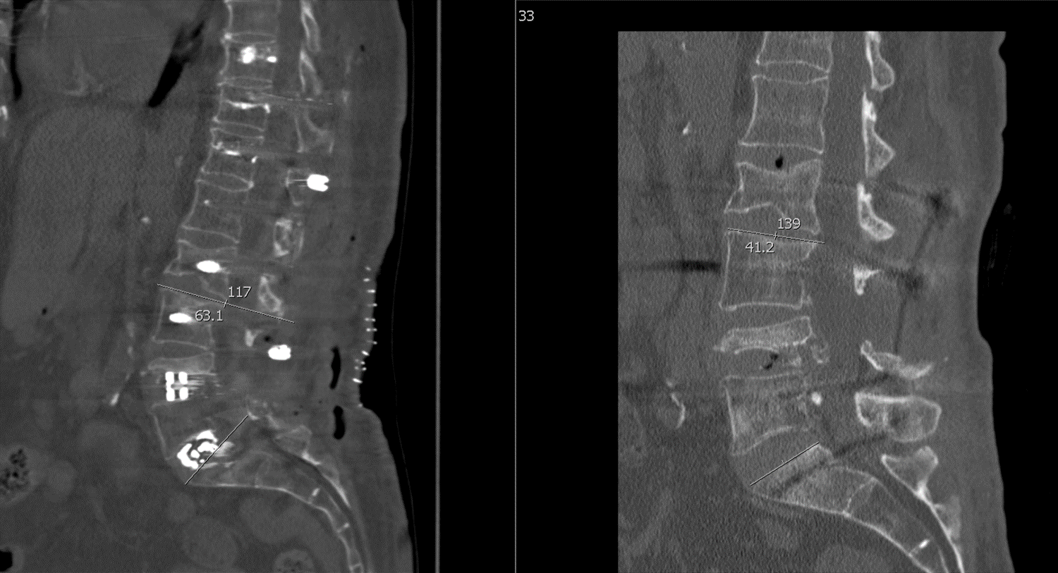 Pedicle Subtraction Osteotomy For Treatment Of Sagittal Plane Deformity