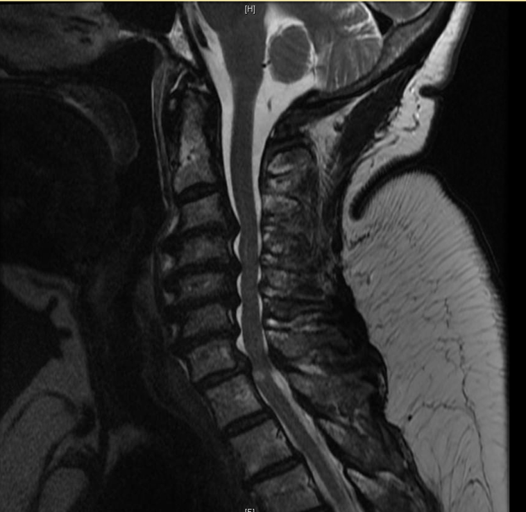 Management of Postoperative Wound Infection with Spinal Instrumentation ...