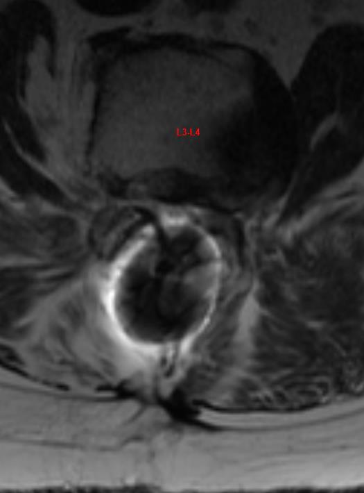 Harrington Rod Extension to the Pelvis and Multilevel Anterior Lumbar