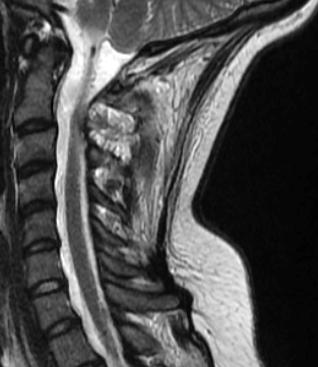 Anteriorposterior Surgical Treatment Of A C2 Aneurysmal Bone Cyst 0527