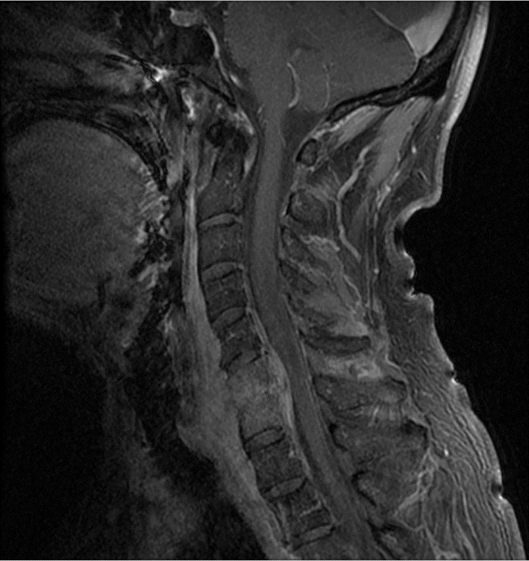 Cervical Corpectomy For Cervical Osteomyelitis Discitis And Epidural 