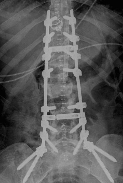 Thoracolumbar-pelvic Fixation for Concomitant Sacral and Lumbar