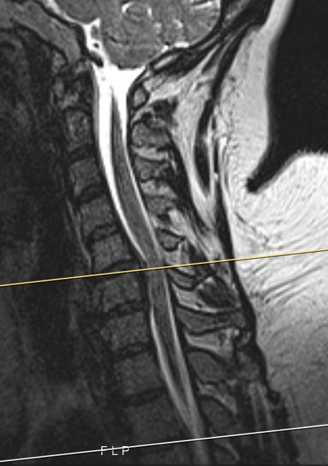 C6 Corpectomy For Cervical Spondylotic Myelopathy Cns