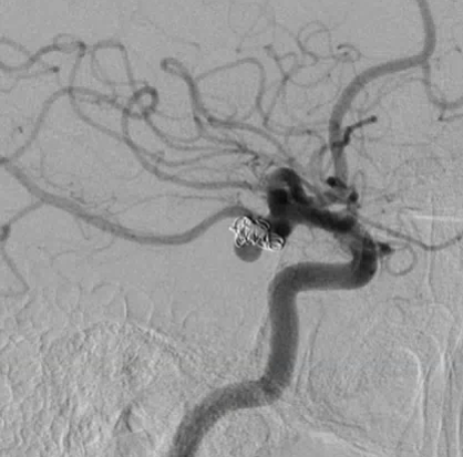 Right pterional craniotomy for clipping of a recurrent PCOM aneurysm ...