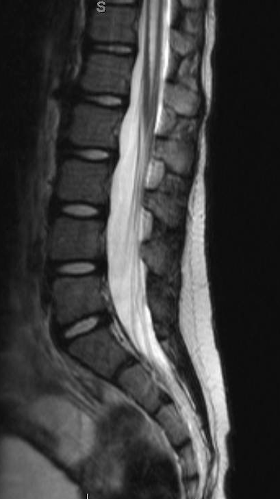 Tethered Cord Release - cns.org