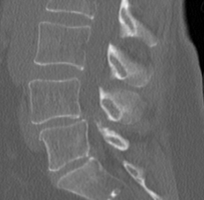 Minimally invasive transforaminal lumbar interbody fusion (TLIF) for ...