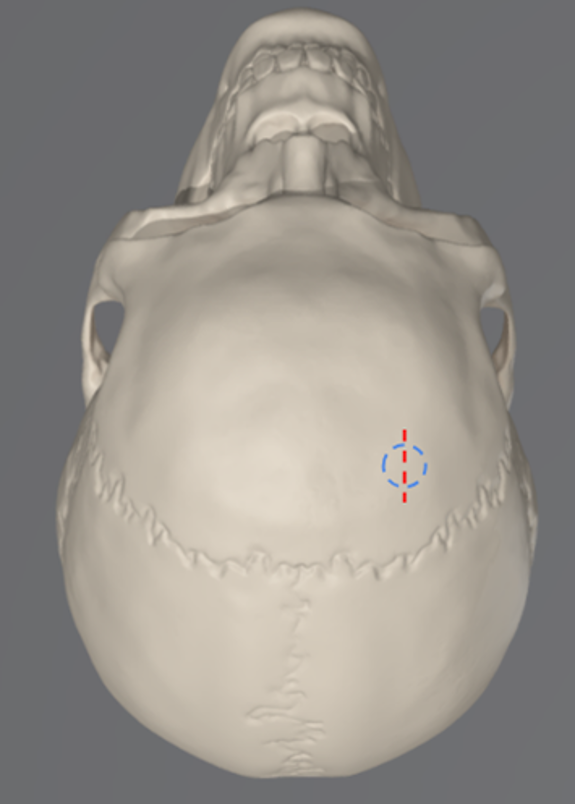 Endoscopic Third Ventriculostomy For The Treatment Of Obstructive