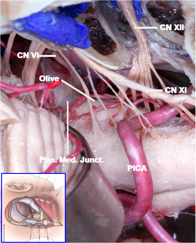 Far Lateral Approach - Congress of Neurological Surgeons (CNS)