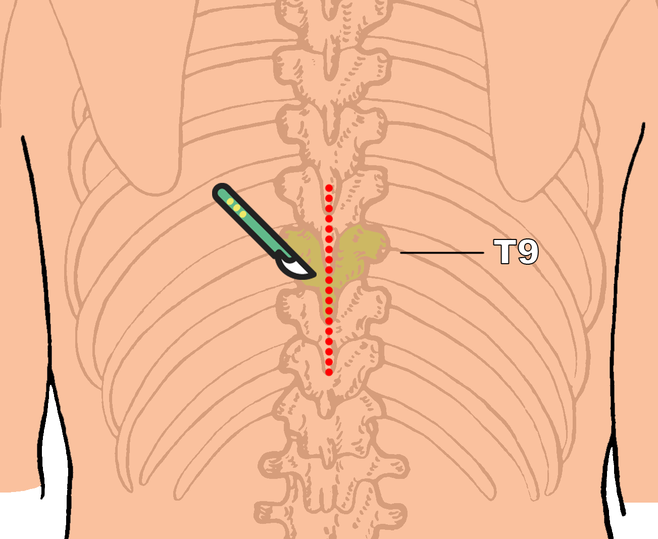 Transpedicular Approach for Resection of Ventral Thoracic Meningioma